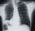 obrazek do "lung cancer" po polsku